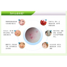 5盒優惠裝】德眾復方珍珠暗瘡片84片去痘祛痘 痤瘡粉刺 清熱解毒