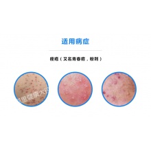 班賽過氧苯甲酰凝膠劑痤瘡閉口粉刺青春痘暗瘡祛痘膏去黑頭軟膏藥